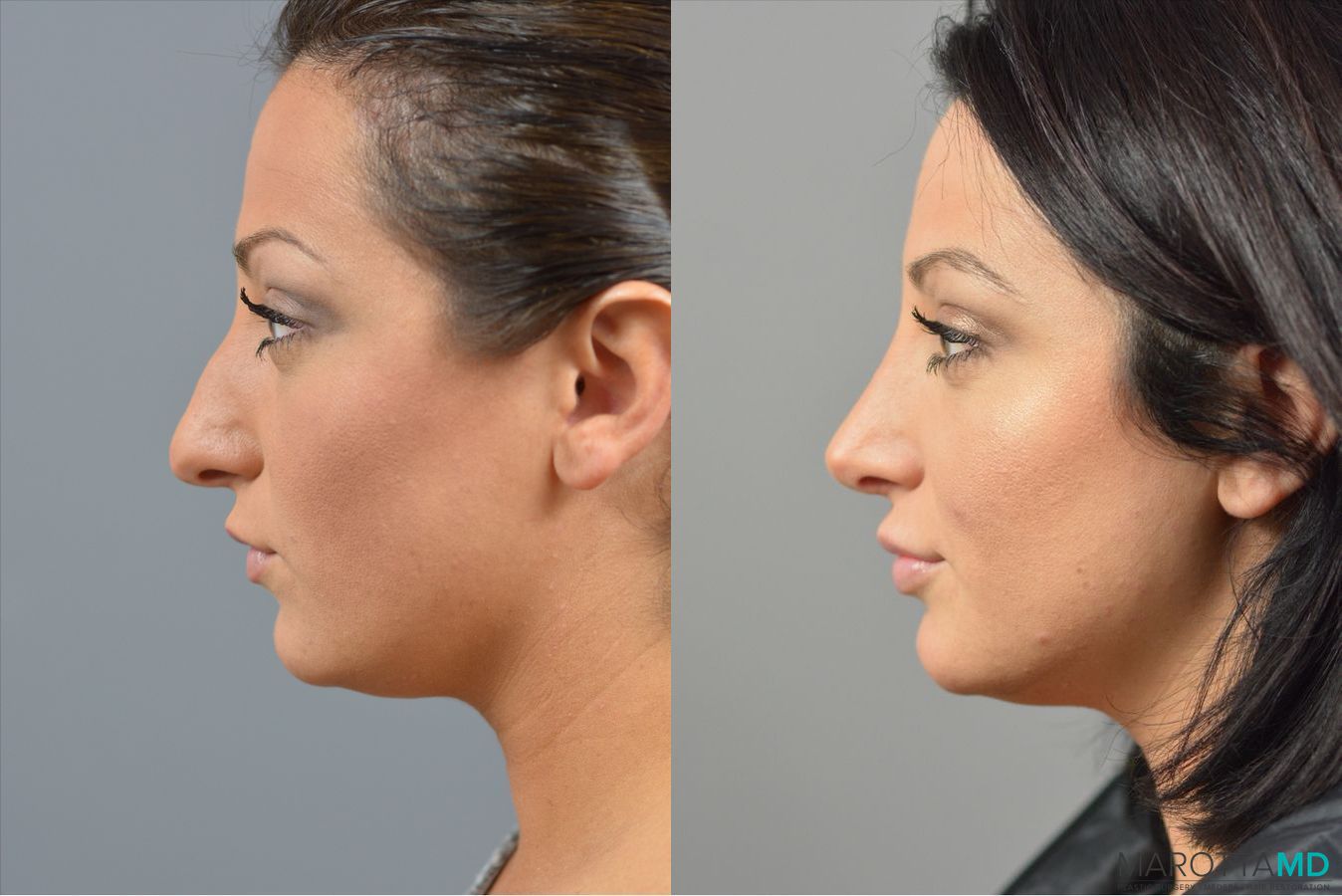 Before and after Rhinoplasty case 41921 - Angle 5