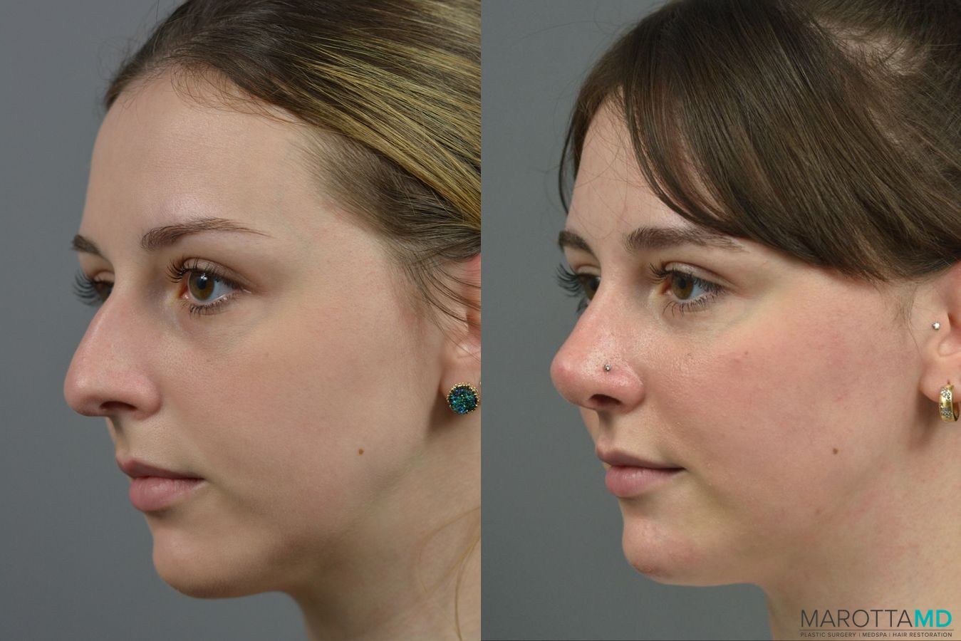 Before and after Rhinoplasty case 23770 - Angle 4