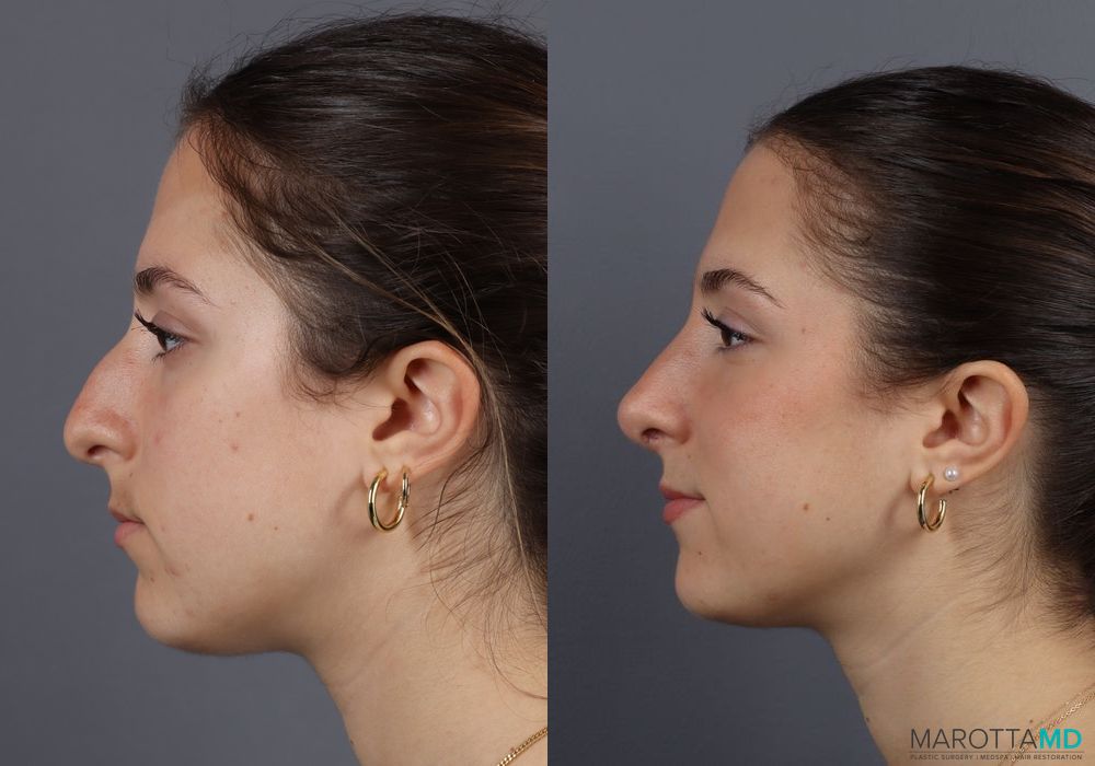 Before and after Rhinoplasty case 7138 - Angle 2