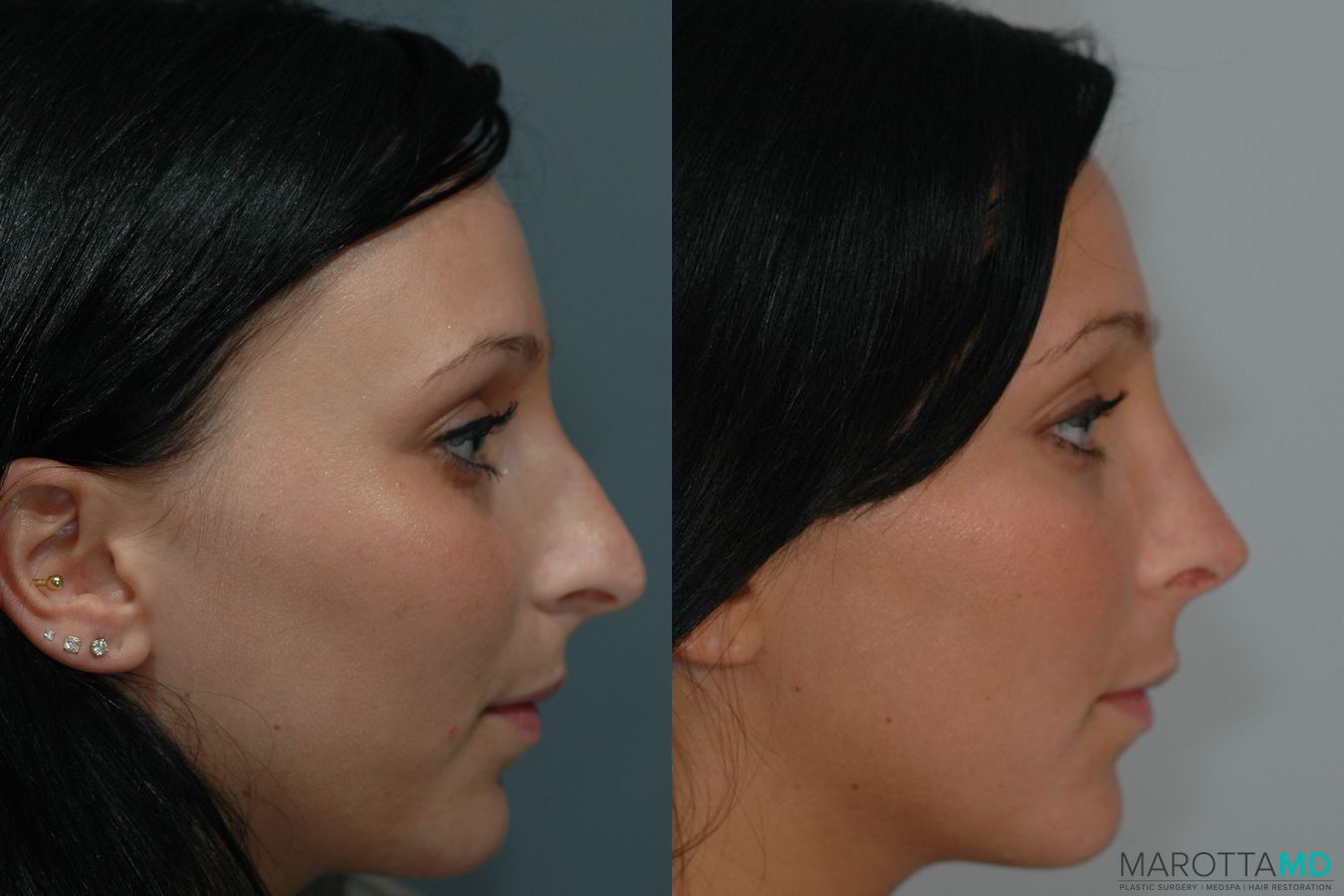 Before and after Rhinoplasty case 41919