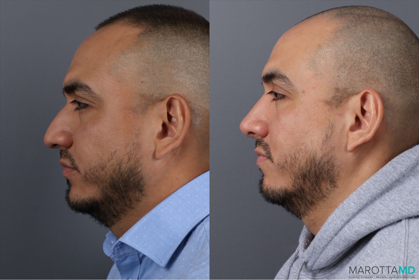 Before and after Rhinoplasty case 21670 - Angle 4