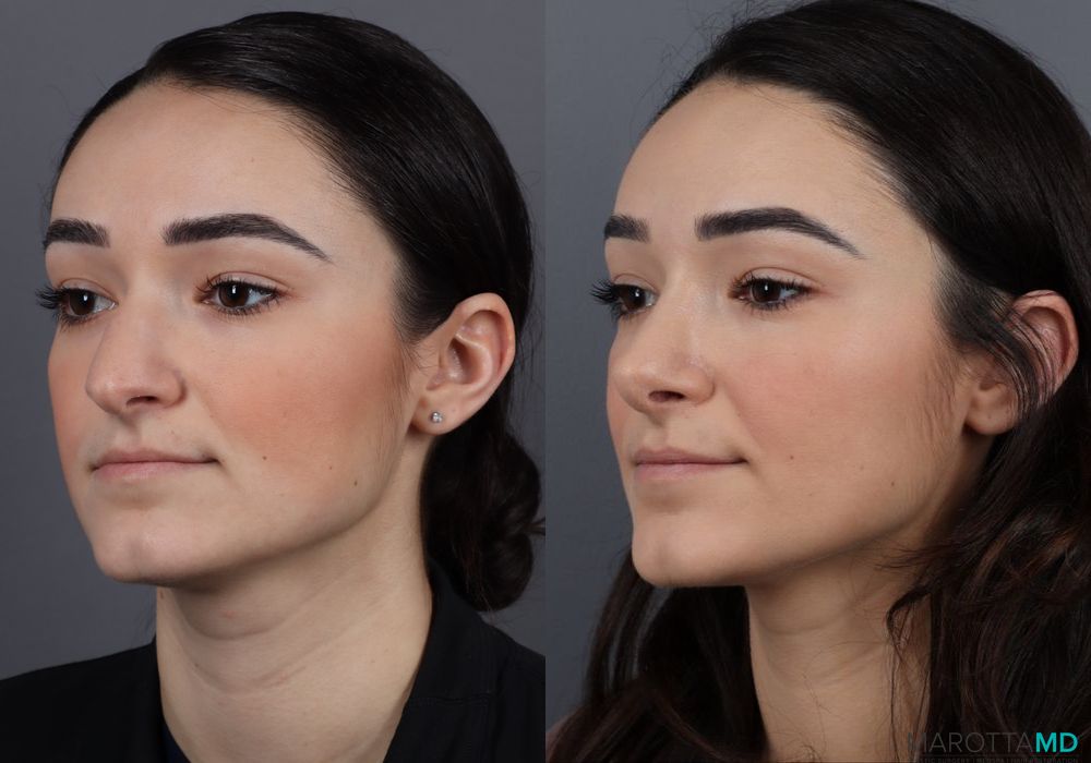 Rhinoplasty - Case 265