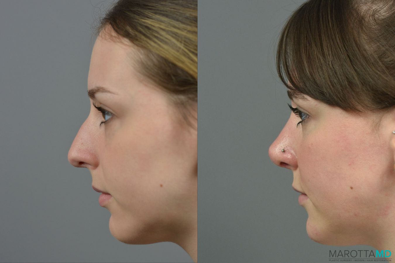 Before and after Rhinoplasty case 23770 - Angle 5