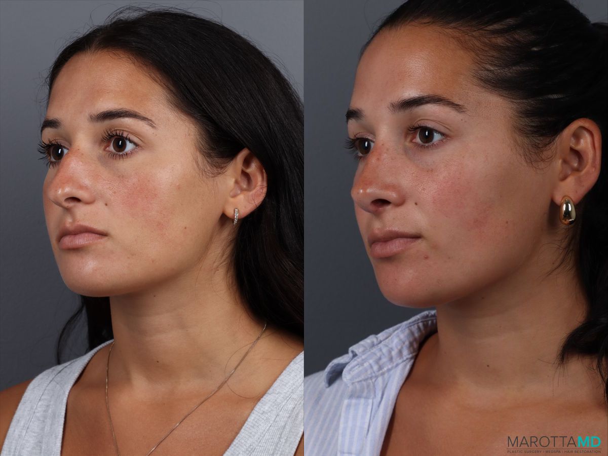 Before and after Rhinoplasty case 19687 - Angle 4
