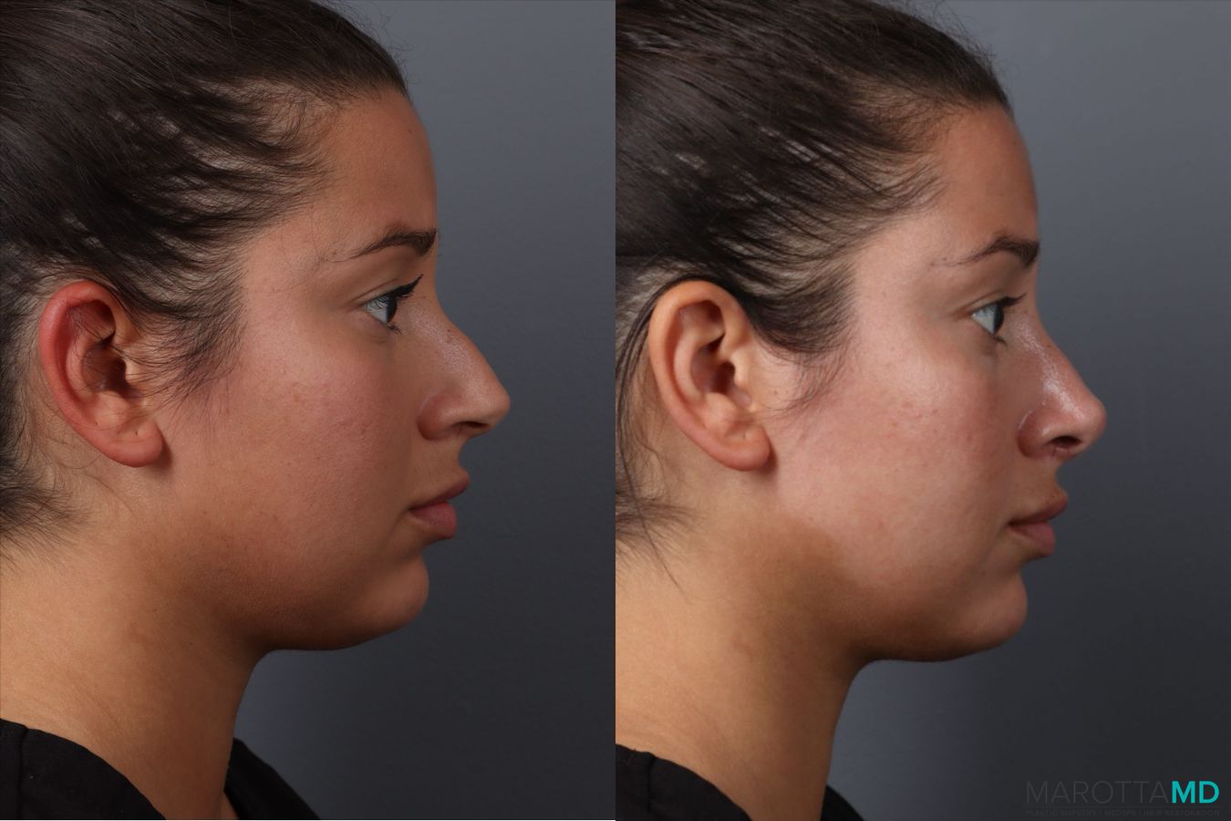 Before and after Rhinoplasty case 49458 - Angle 3