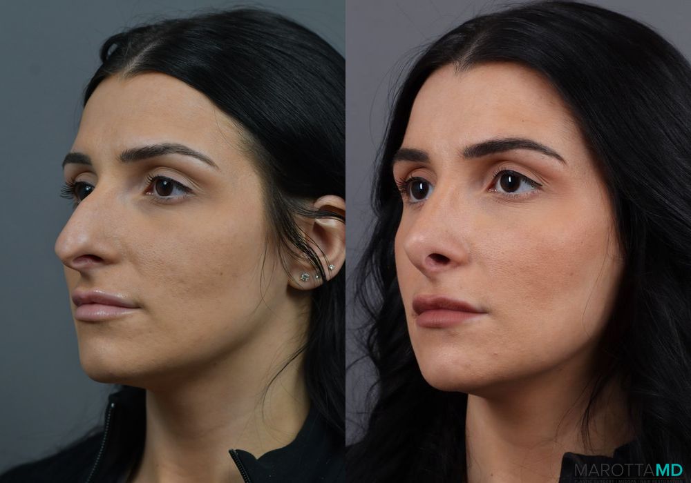 Rhinoplasty - Thumbnail 4