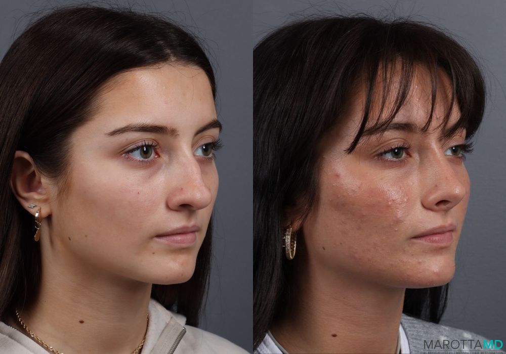 Rhinoplasty - Thumbnail 4