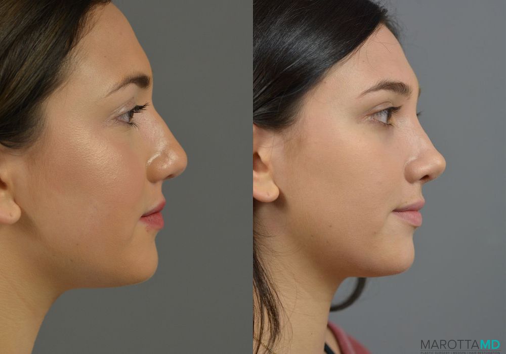 Rhinoplasty - Thumbnail 4