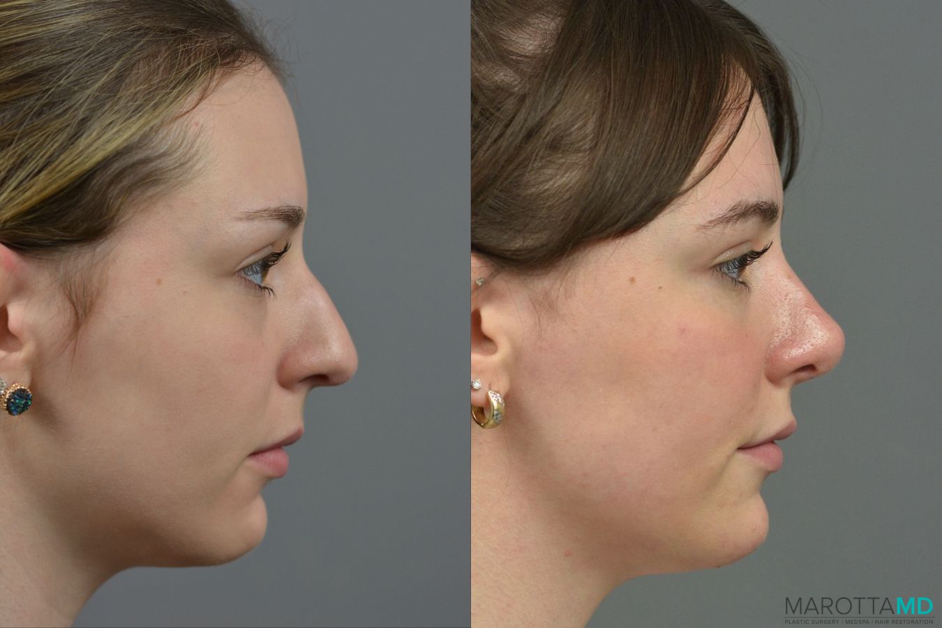 Before and after Rhinoplasty case 23770 - Angle 3