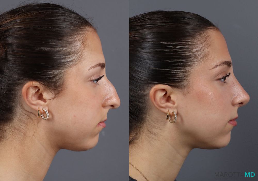 Before and after Rhinoplasty case 7139 - Angle 5