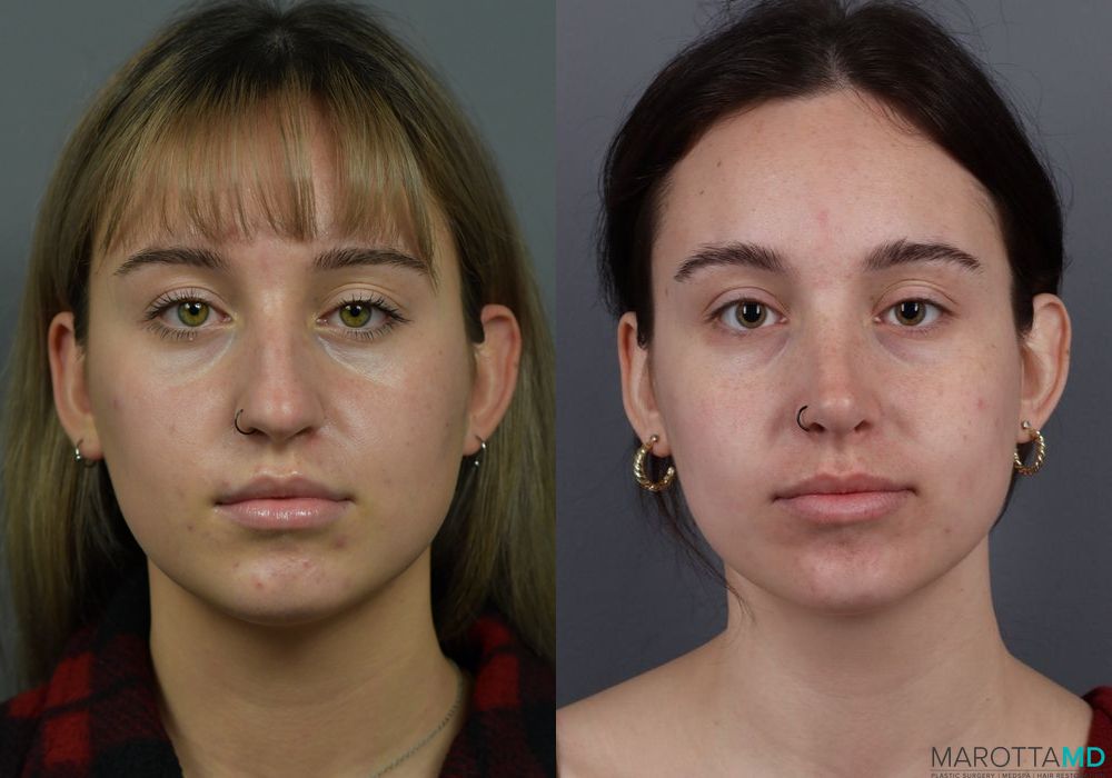 Rhinoplasty - Thumbnail 5