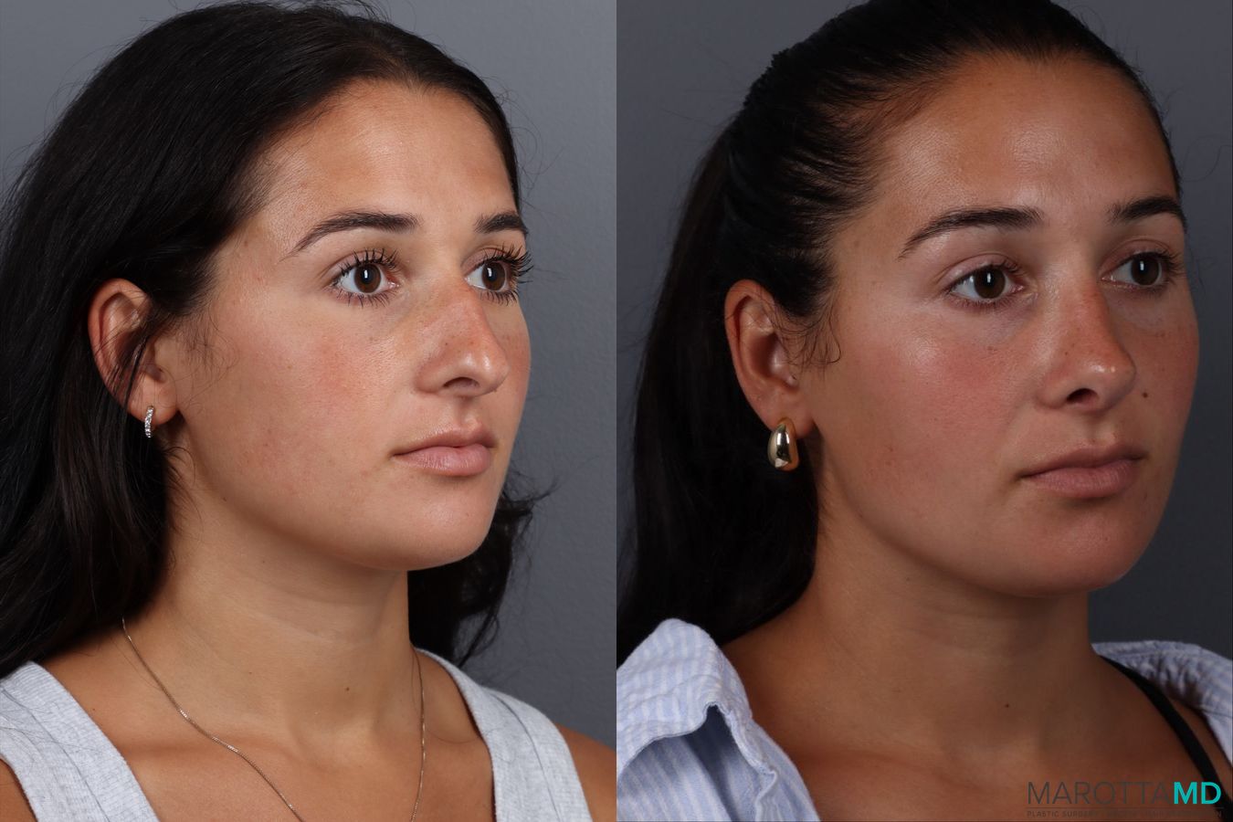 Before and after Rhinoplasty case 19687 - Angle 2