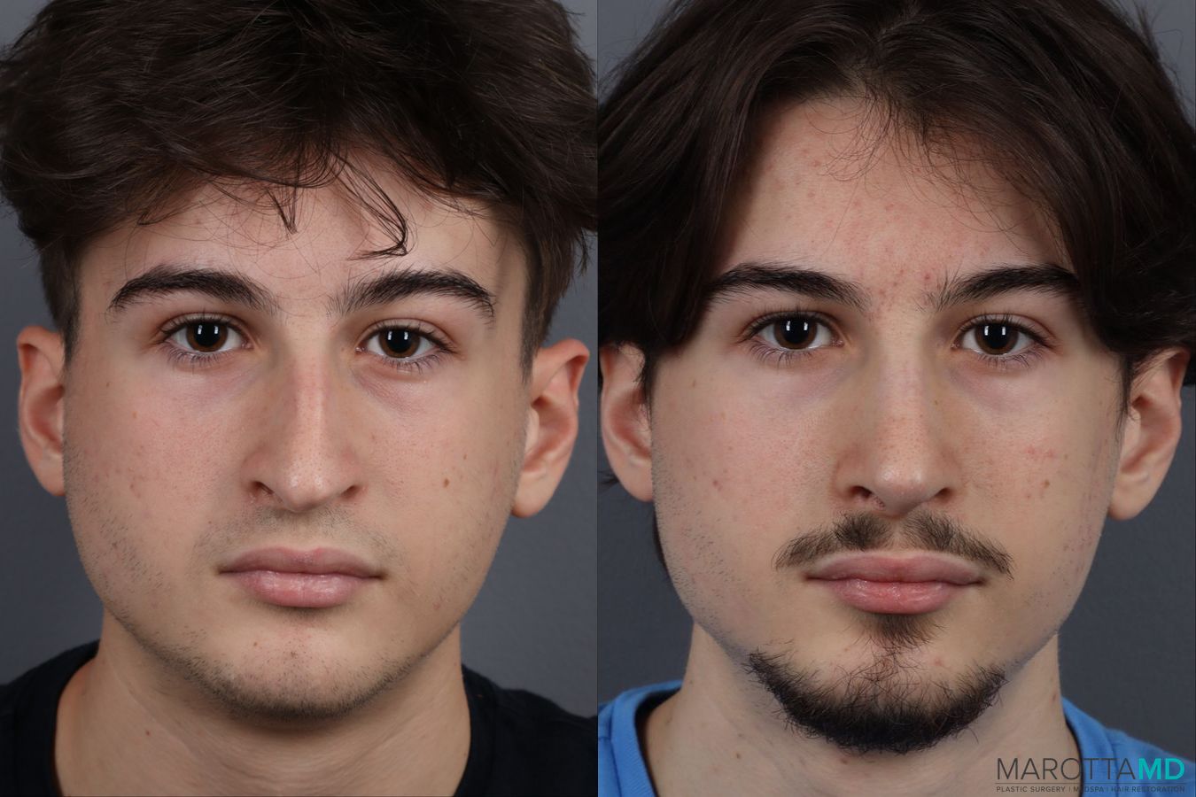 Before and after Rhinoplasty case 12828