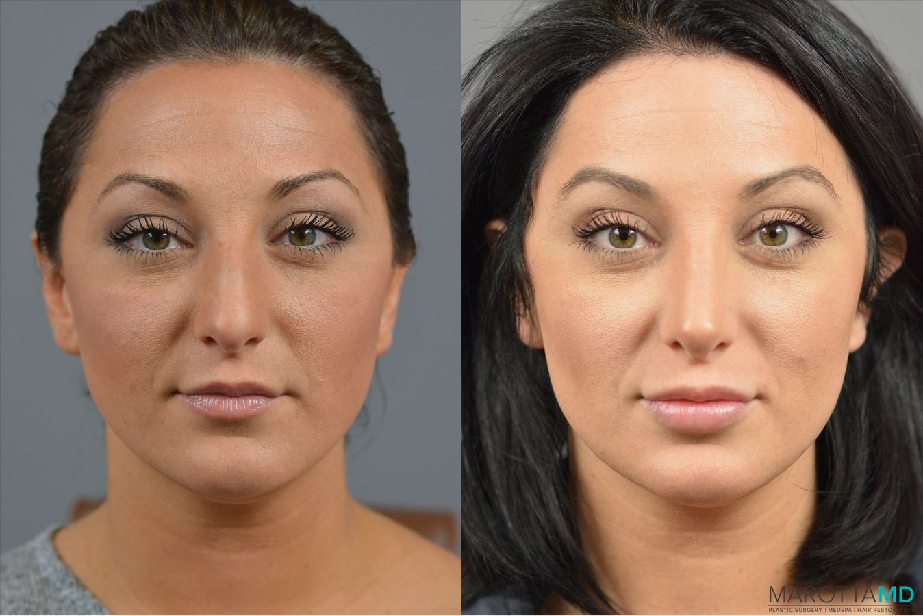 Before and after Rhinoplasty case 41921