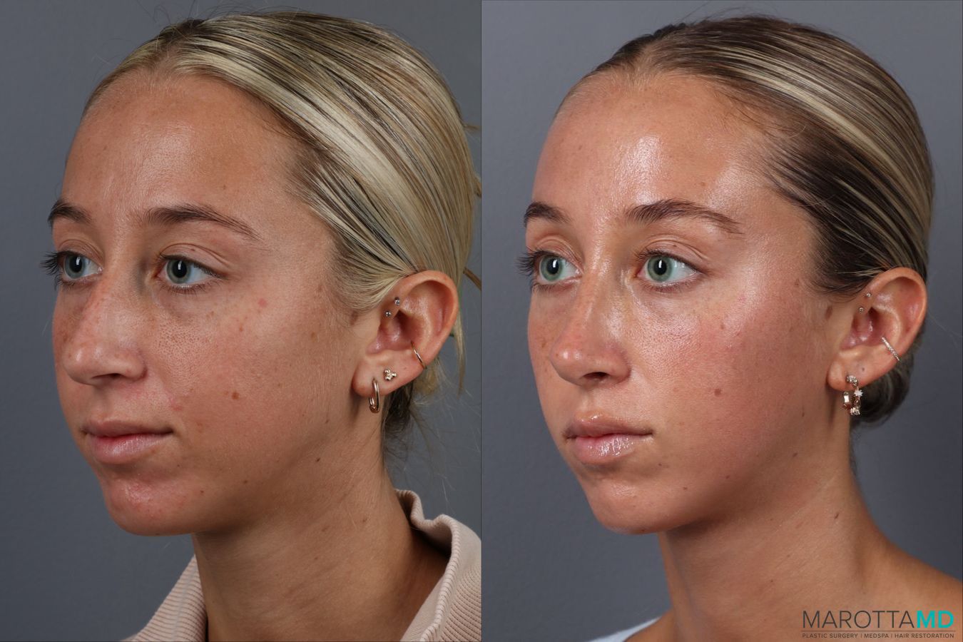 Before and after Rhinoplasty case 18368 - Angle 4