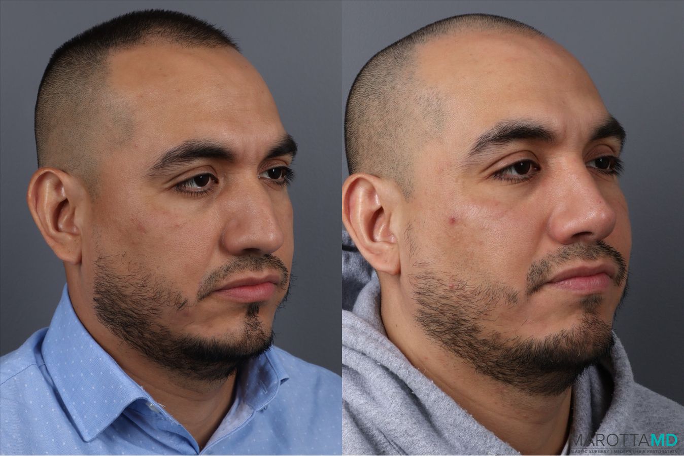 Before and after Rhinoplasty case 21670 - Angle 2