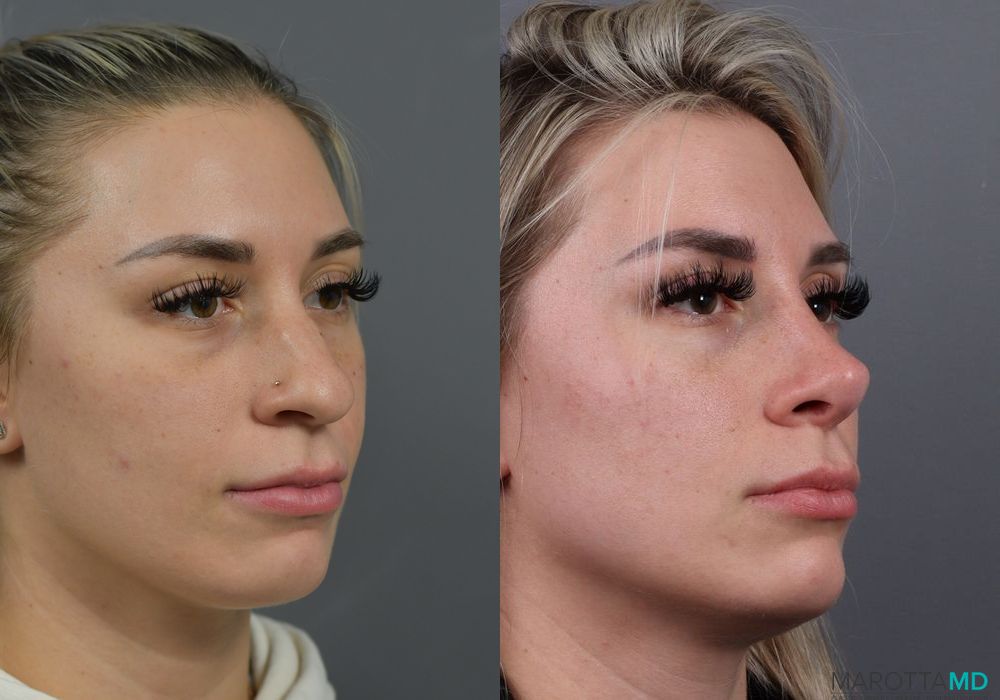 Before and after Rhinoplasty case 7284 - Angle 2