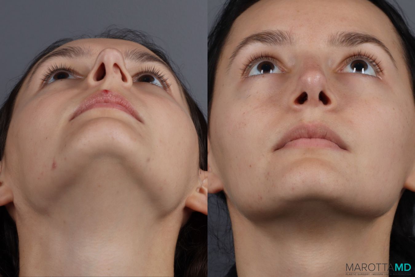 Before and after Rhinoplasty case 13237 - Angle 6