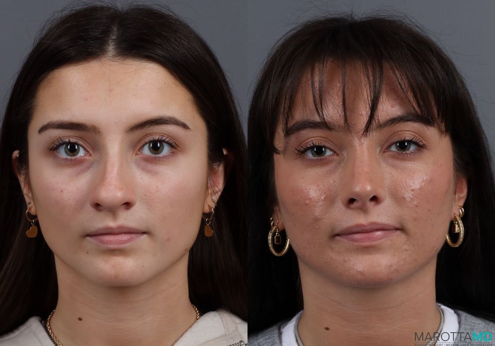 Rhinoplasty - Thumbnail 2