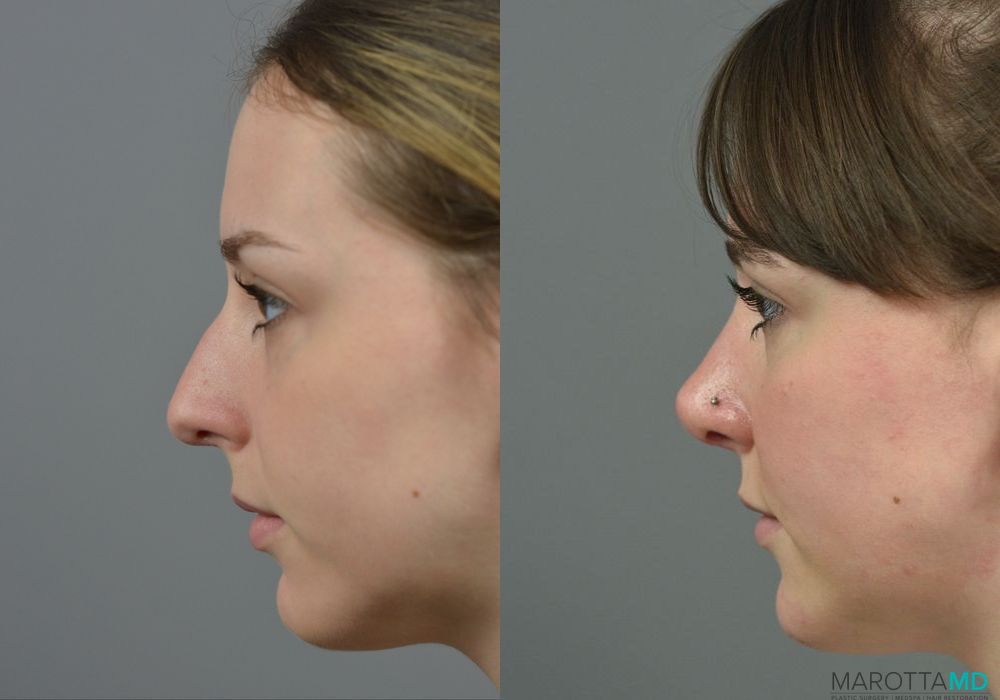 Rhinoplasty - Thumbnail 5