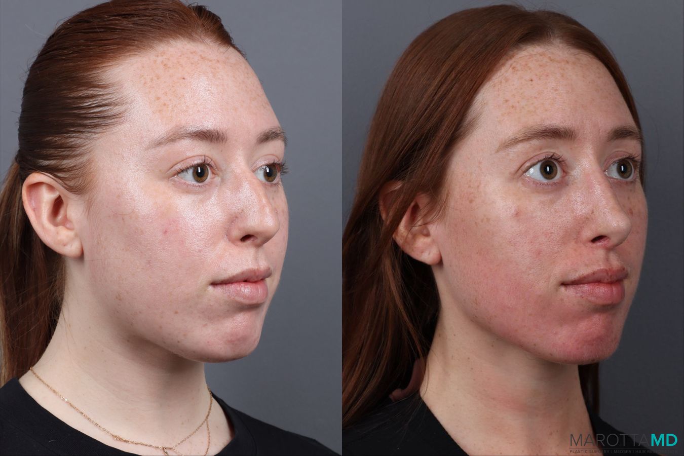 Before and after Rhinoplasty case 19923 - Angle 2
