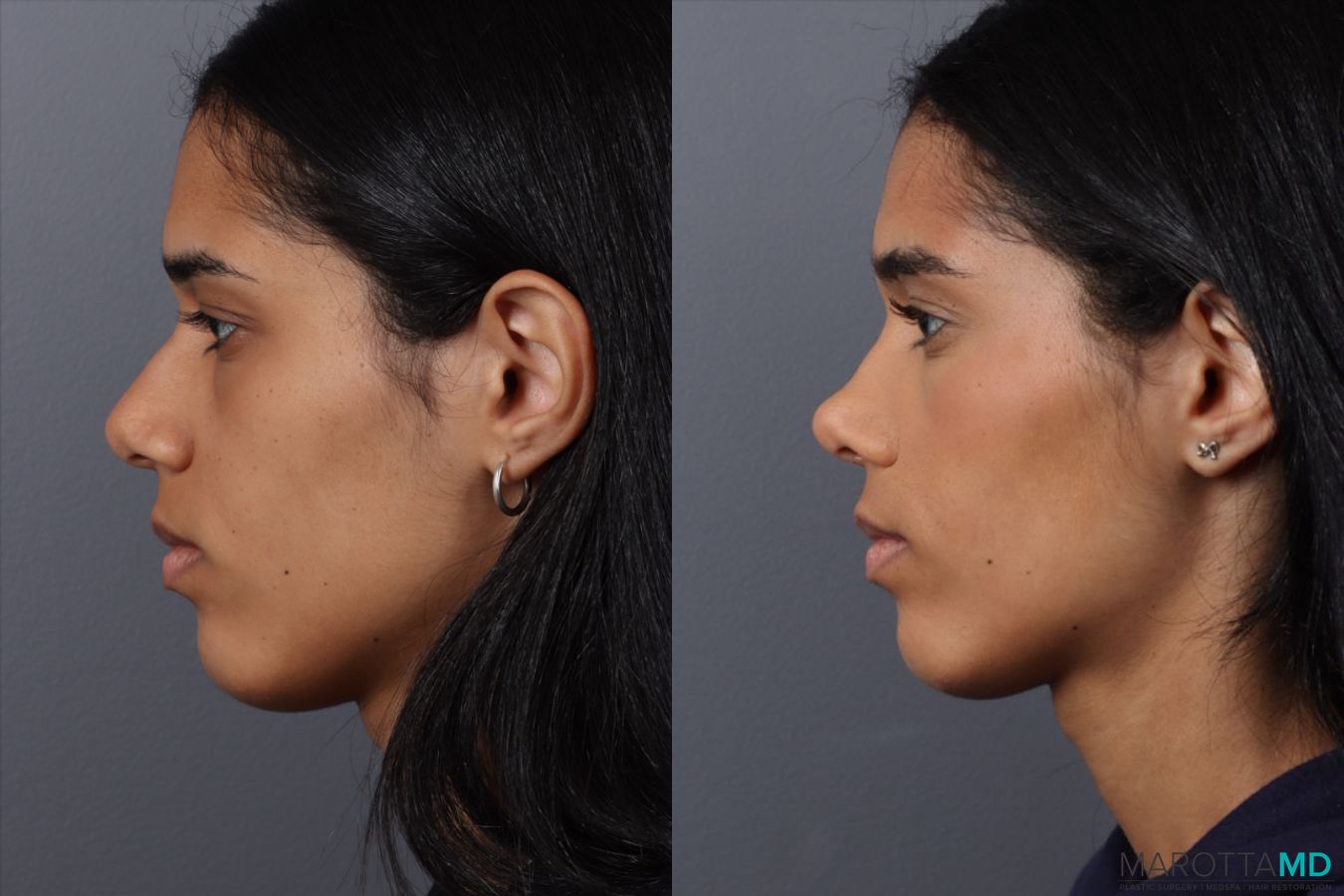 Before and after Rhinoplasty case 49459 - Angle 5