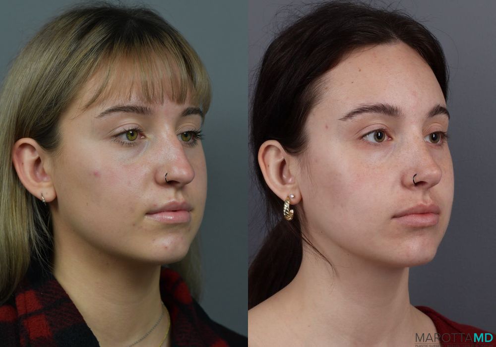 Rhinoplasty - Case 608