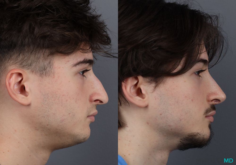 Rhinoplasty - Thumbnail 4