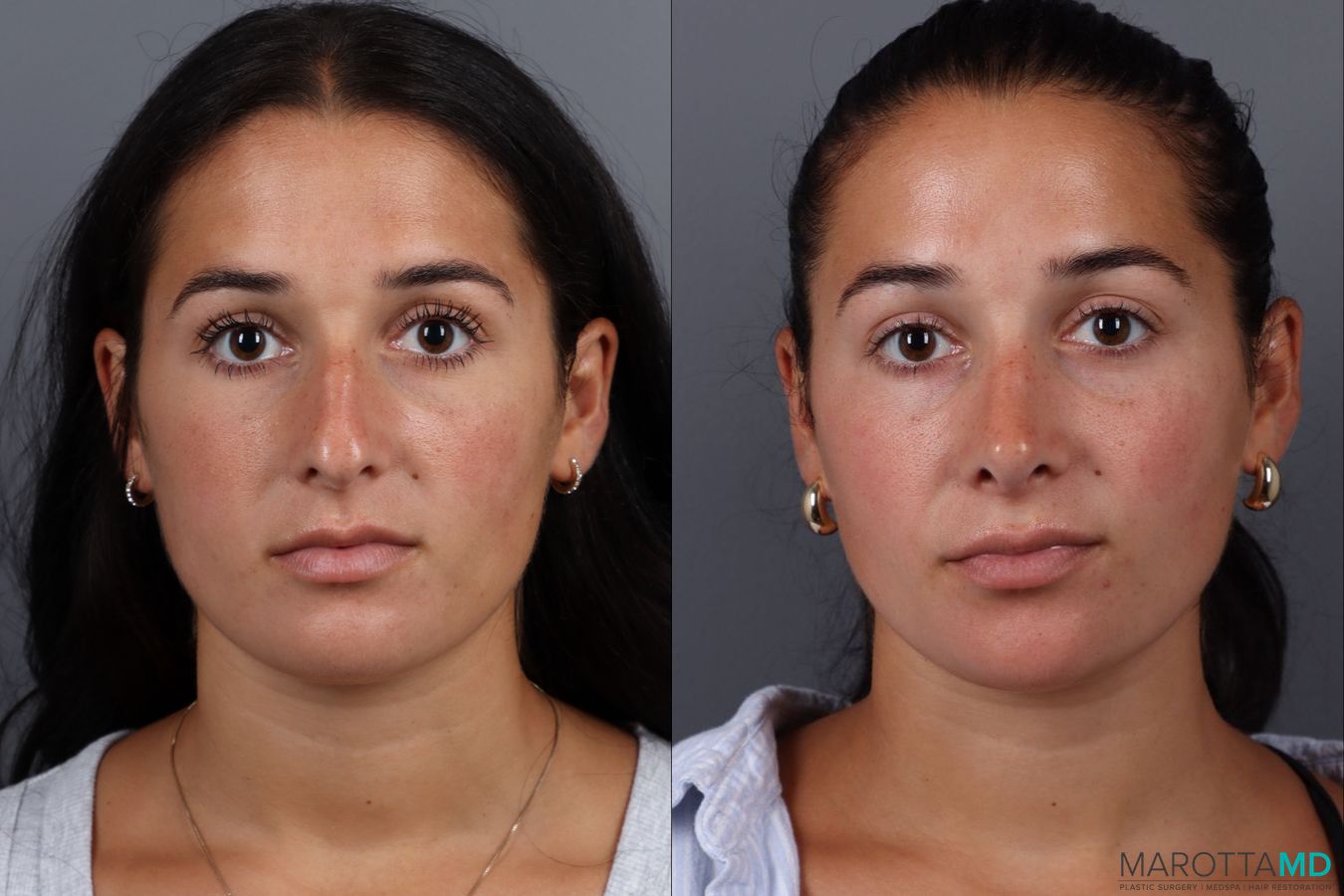 Before and after Rhinoplasty case 19687