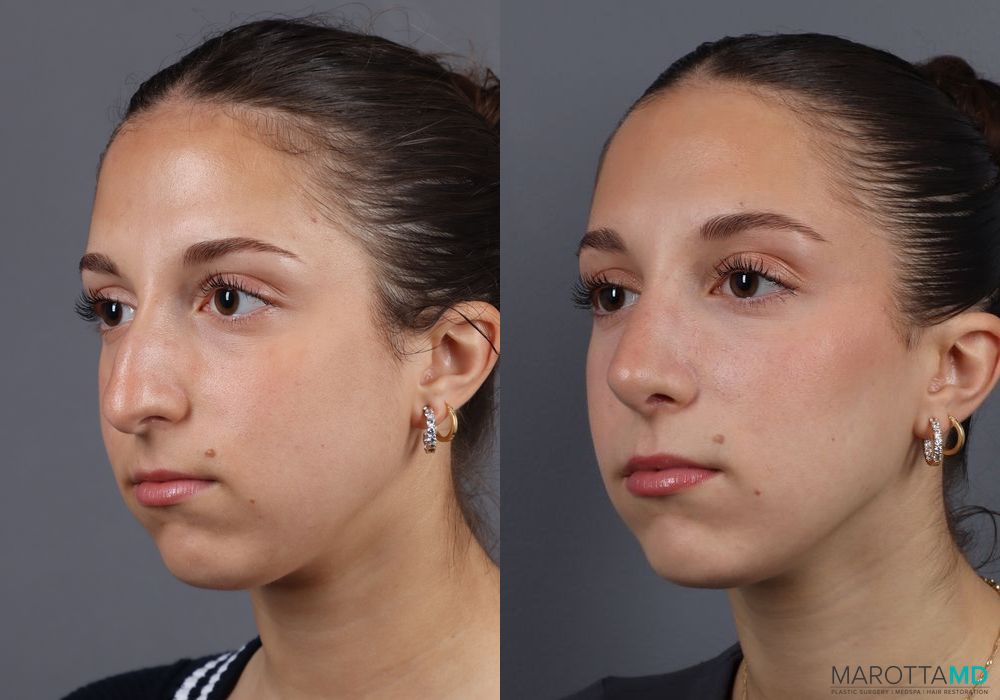 Before and after Rhinoplasty case 7139 - Angle 3