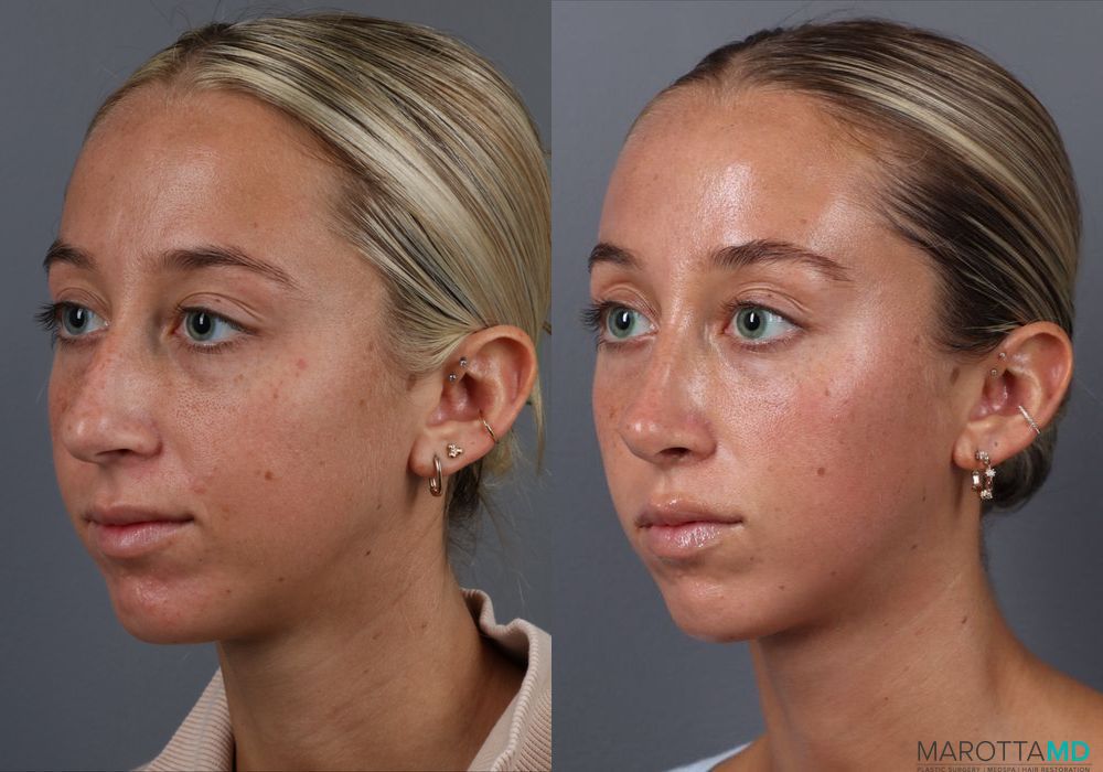 Rhinoplasty - Thumbnail 4