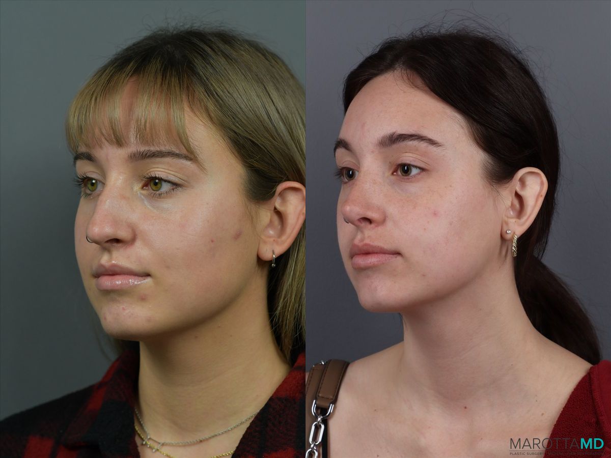 Before and after Rhinoplasty case 12317 - Angle 4