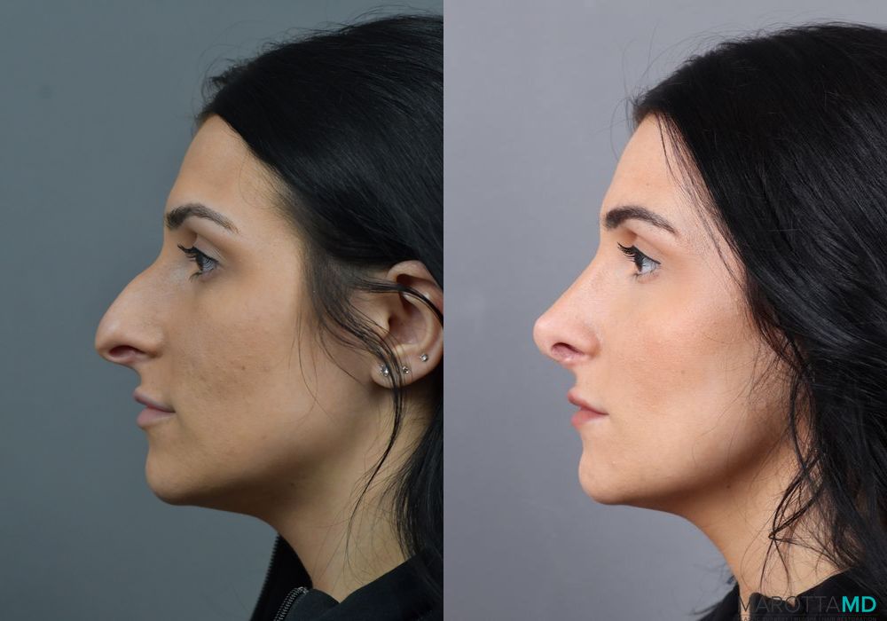 Rhinoplasty - Thumbnail 5