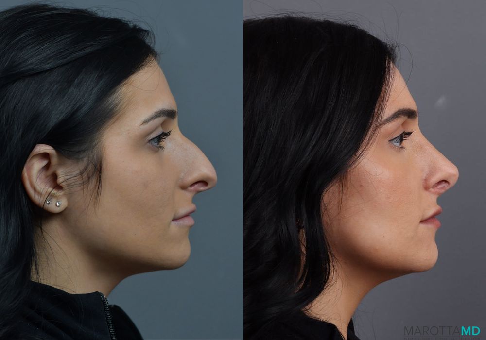 Rhinoplasty - Thumbnail 3