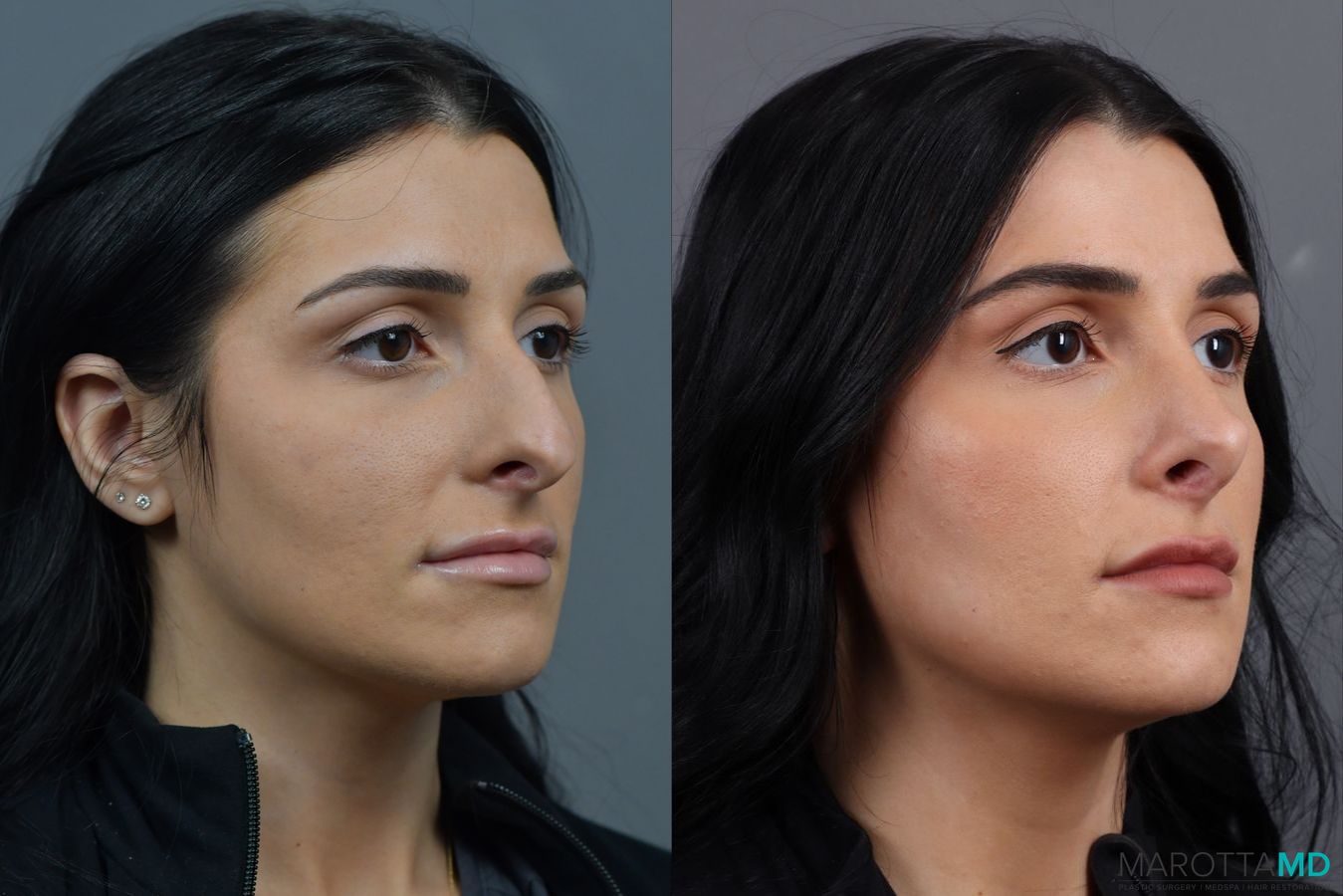 Before and after Rhinoplasty case 17406 - Angle 2