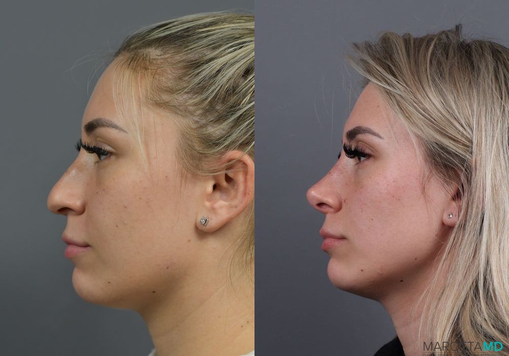 Before and after Rhinoplasty case 7284 - Angle 5