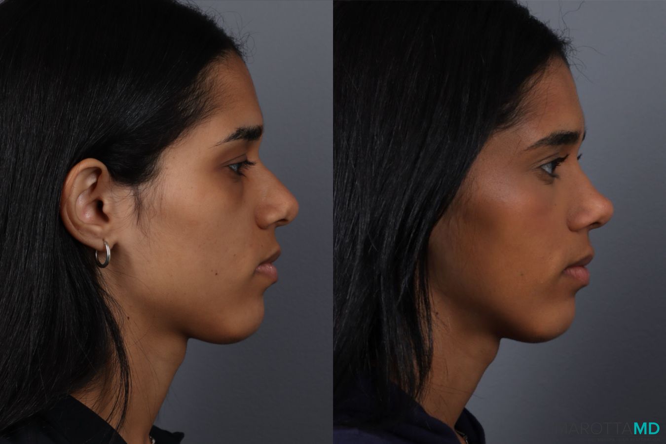 Before and after Rhinoplasty case 49459 - Angle 3