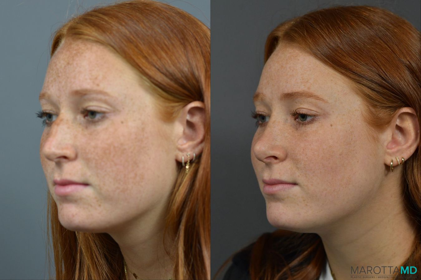 Before and after Rhinoplasty case 16102 - Angle 4