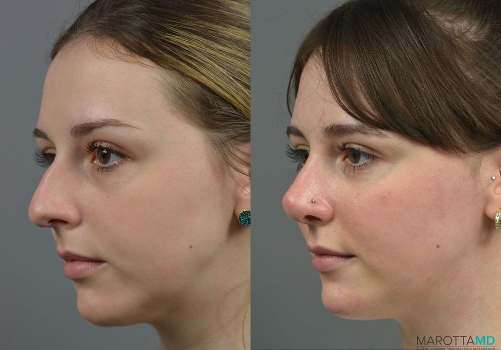 Rhinoplasty - Thumbnail 4