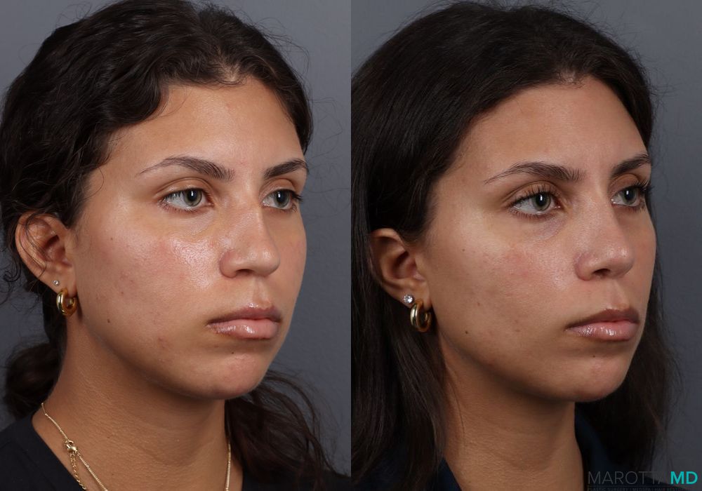 Rhinoplasty - Thumbnail 5