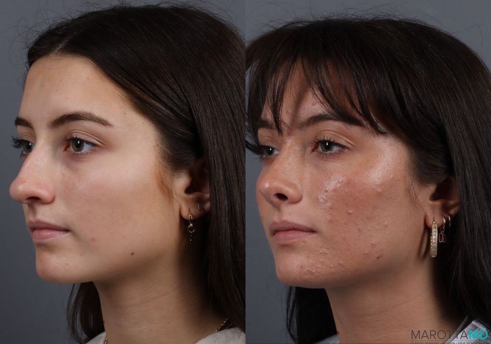 Rhinoplasty - Thumbnail 5