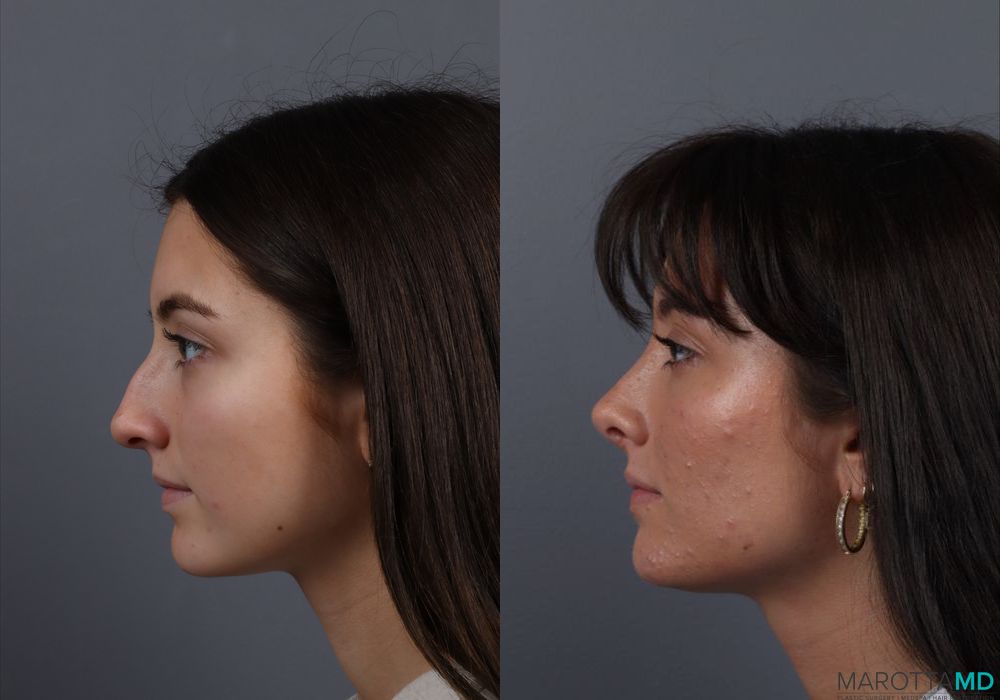 Rhinoplasty - Case 607