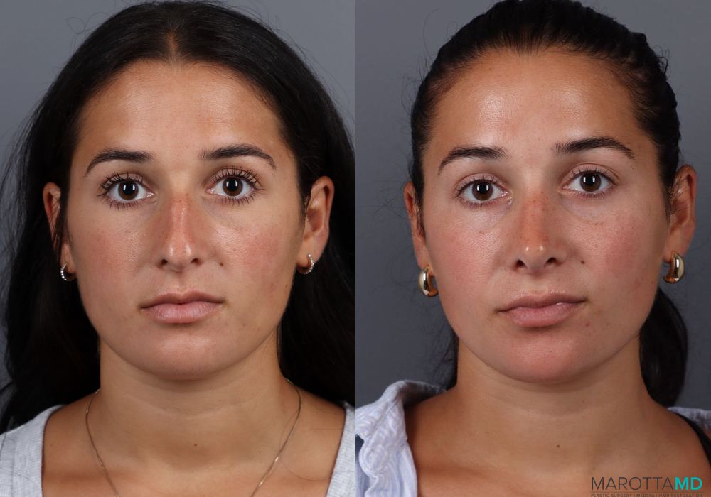 Rhinoplasty - Case 273
