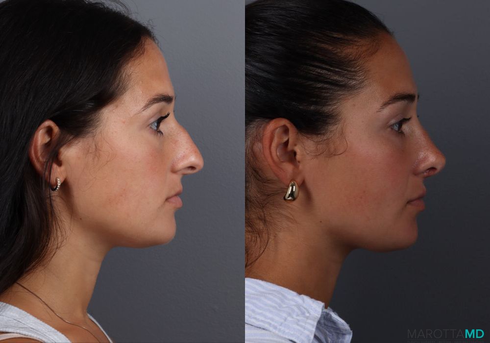 Rhinoplasty - Thumbnail 3
