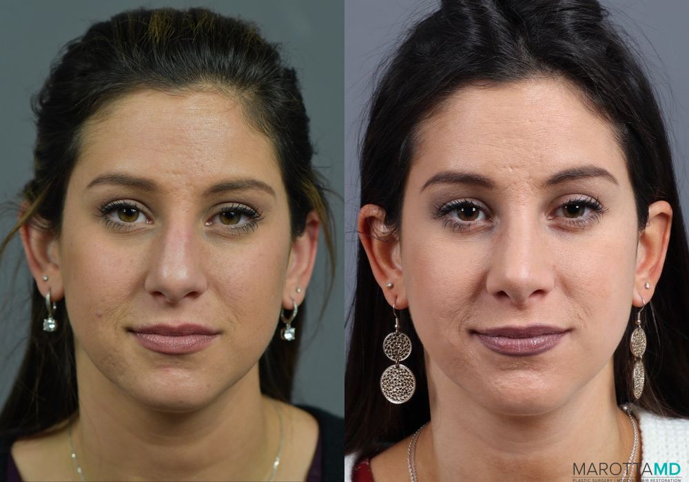 Rhinoplasty - Case 270