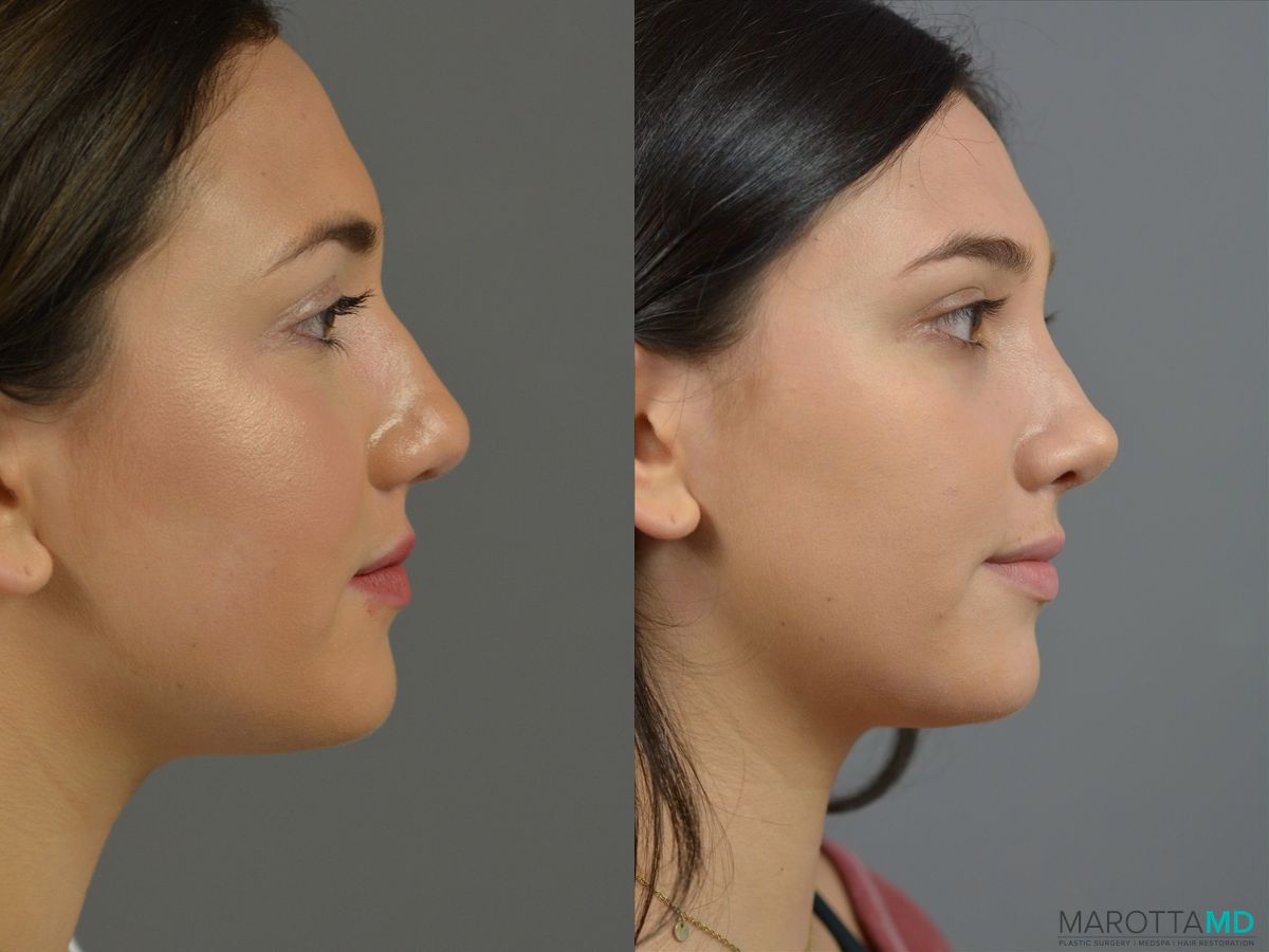 Before and after Rhinoplasty case 18387 - Angle 4