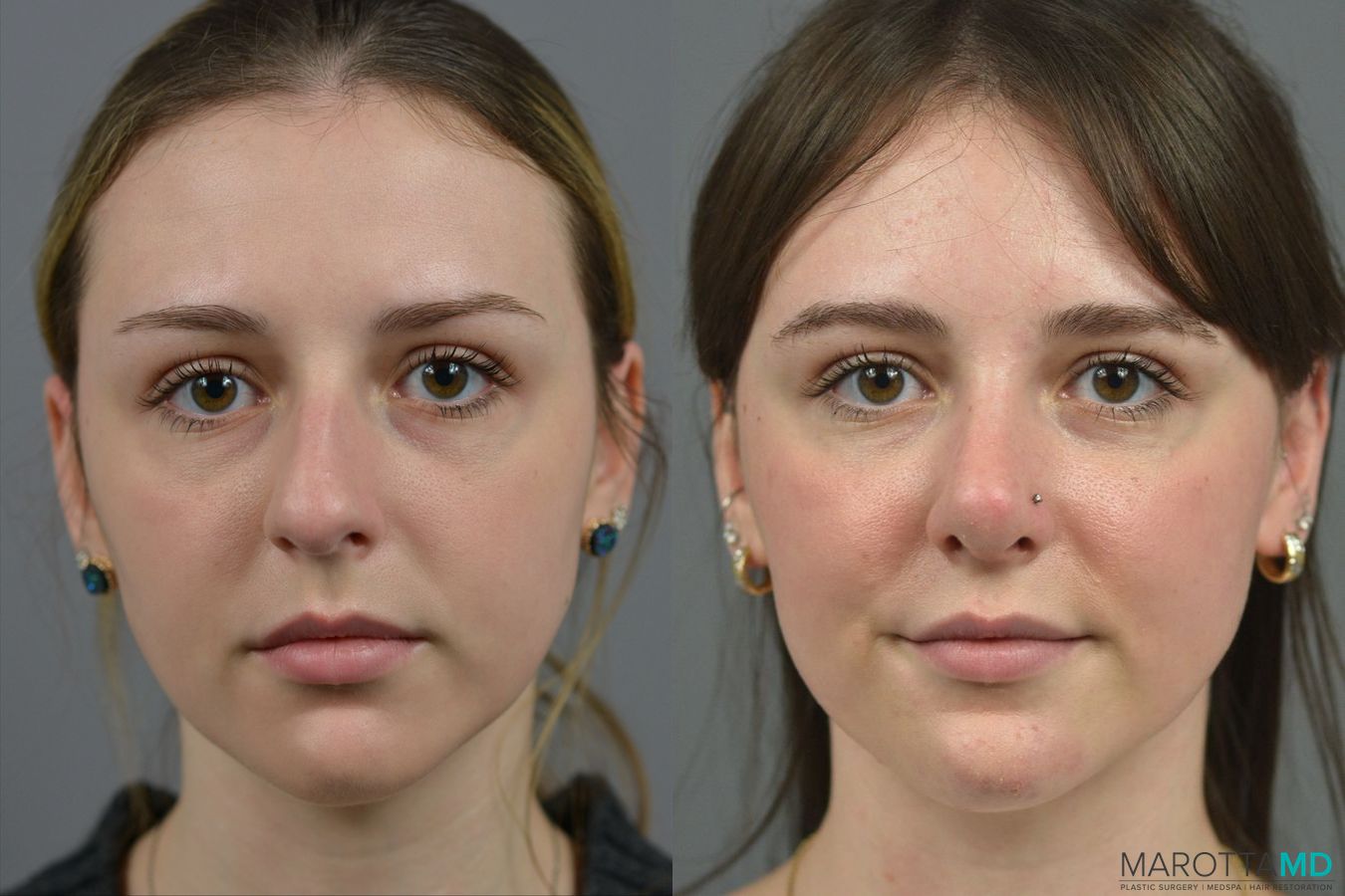Before and after Rhinoplasty case 23770