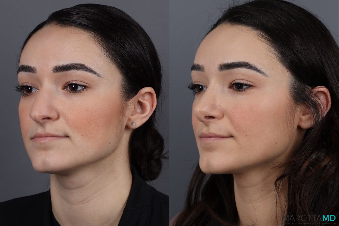 Before and after Rhinoplasty case 13004 - Angle 4