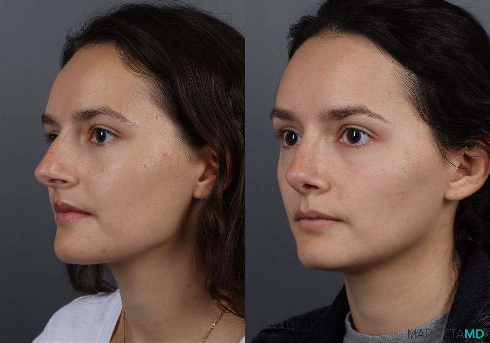 Rhinoplasty - Thumbnail 2