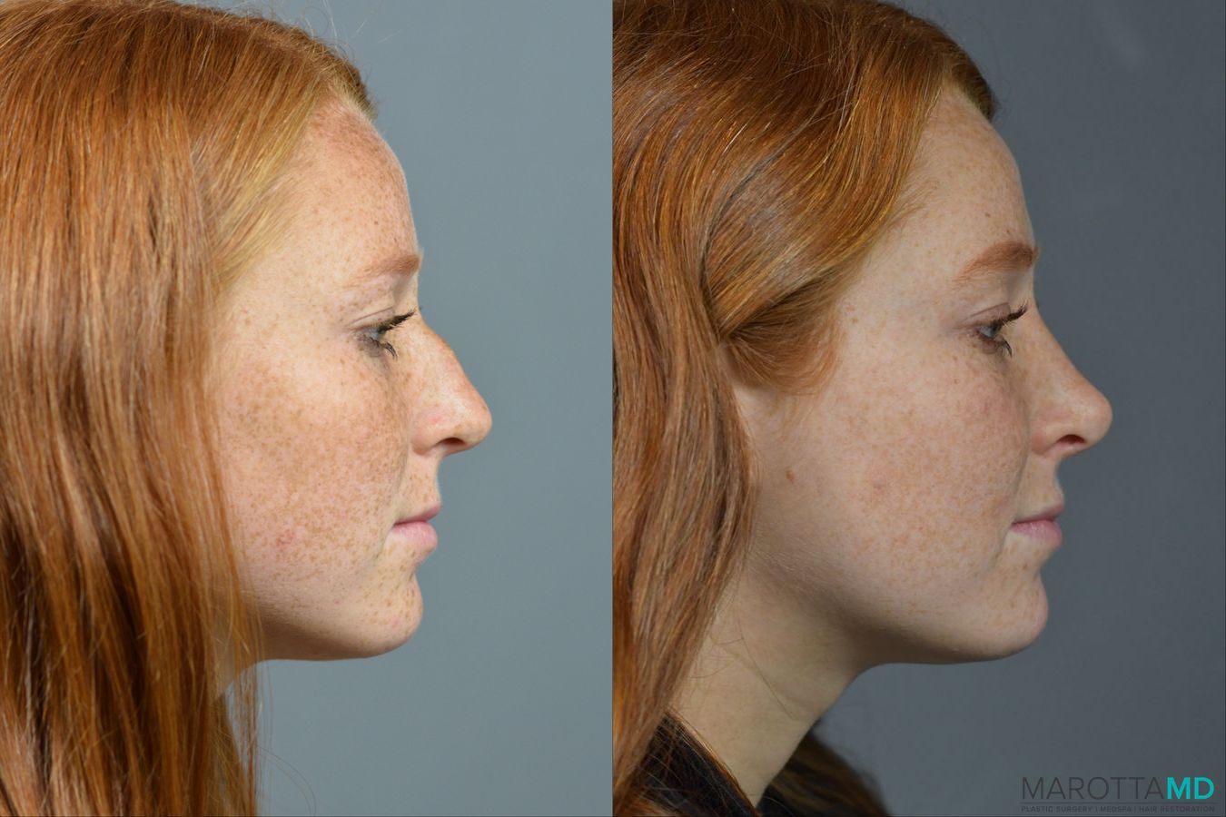 Before and after Rhinoplasty case 16102 - Angle 3